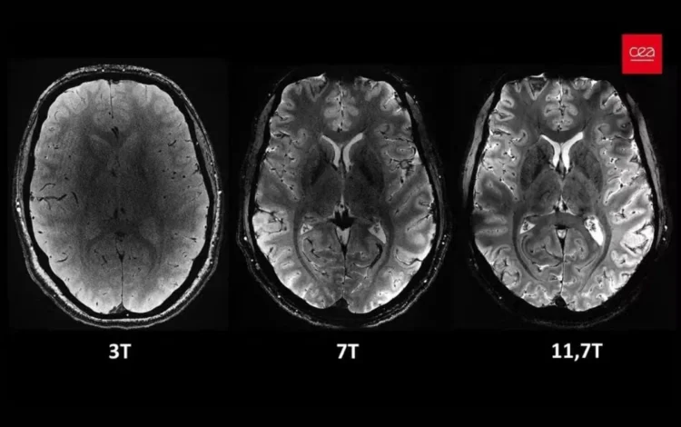 cérebro humano, órgão cerebral